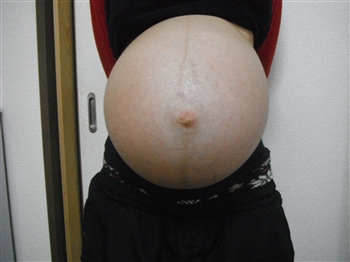 双子,妊娠,体重増加,腹囲,妊娠線妊娠中のお腹