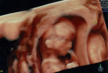 双子,クリフム,ダウン症,確率,胎児ドッグ,絨毛検査,費用双子　初期胎児ドッグ