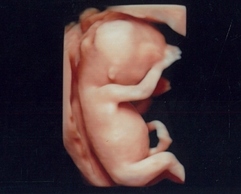 クリフム,初期胎児ドッグ,費用,ダウン症,確率初期胎児ドッグ